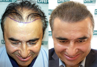 How Long Hair Transplant Last  How is Hair Transplant Done