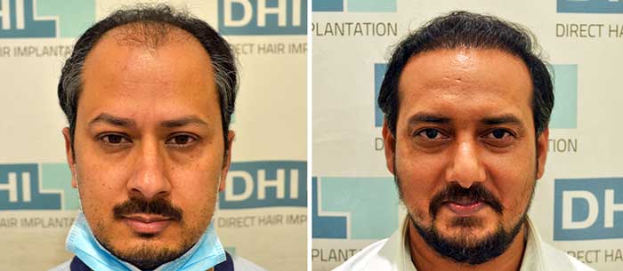 Hair Transplant Before After Pictures