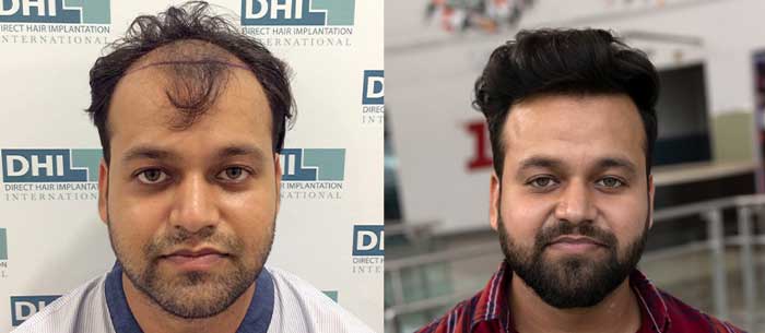 Hair Transplant Before After Pictures