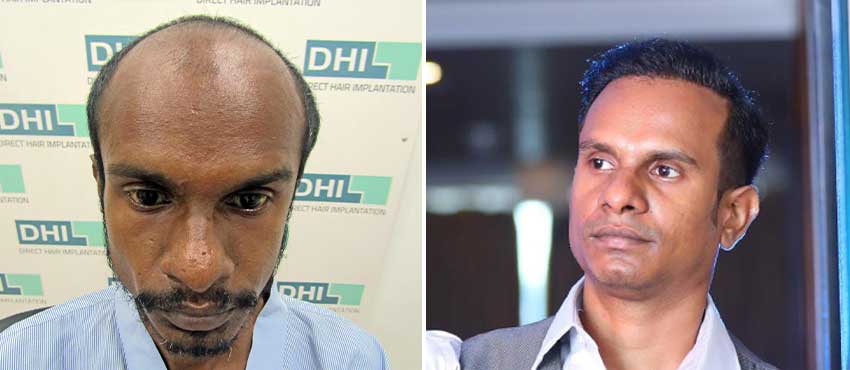 Hair Transplant Before After Pictures