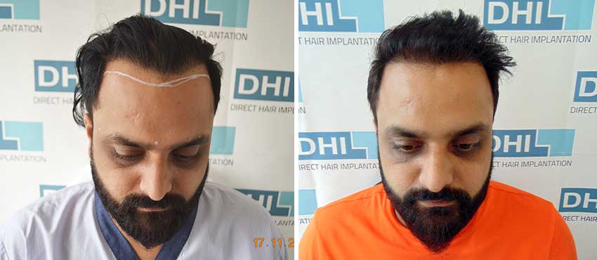 Hair Transplant Before after images