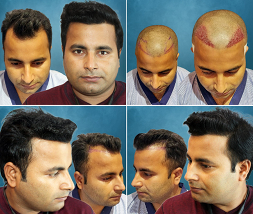 Post Hair Transplant Procedure Precautions
