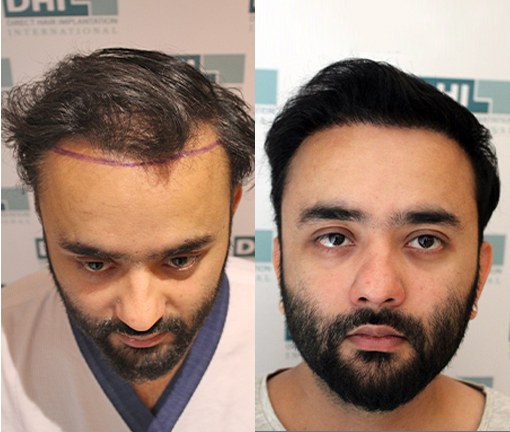 Hair Line Results after DHI Hair Transplant Procedure