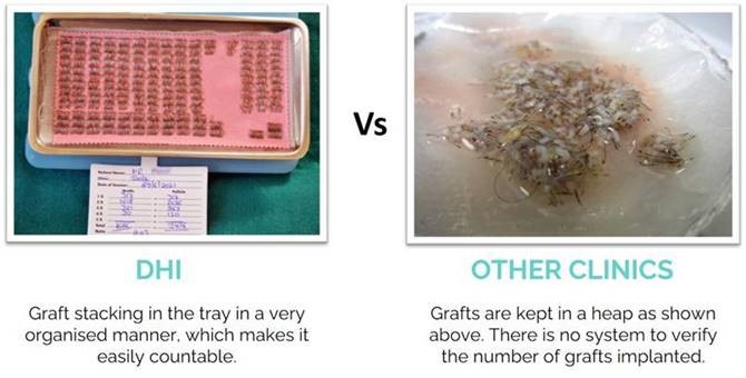 Graft Tray in DHI - Direct Hair Implantation Versus FUE Technique