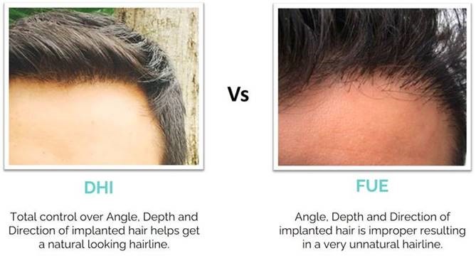 Results from DHI - Direct Hair Implantation Versus FUE Technique