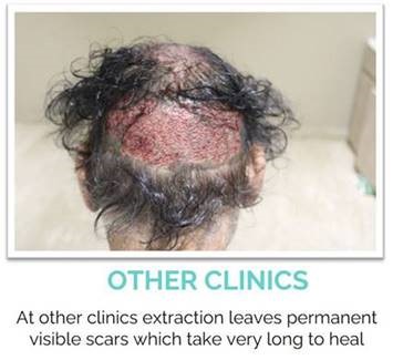 Other Technique Hair Transplant Scar Image