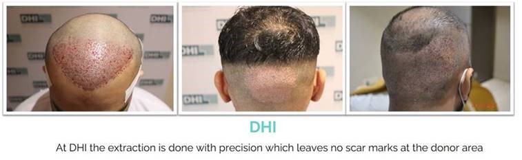 NO SCAR DHI HAIR TRANSPLANT TECHNIQUE