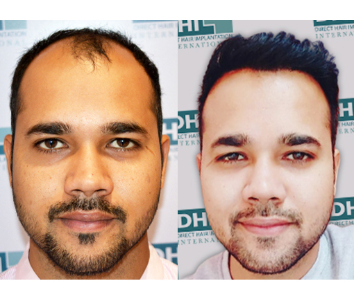 Hair Transplant Before and after Results