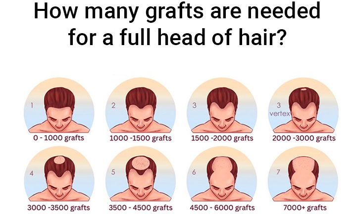 How many grafts are needed for a full head of hair How many grafts are needed for a full head of hair