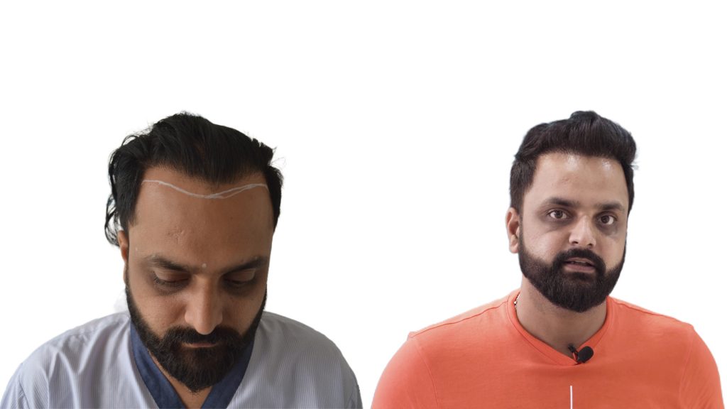 understanding receding hairlines