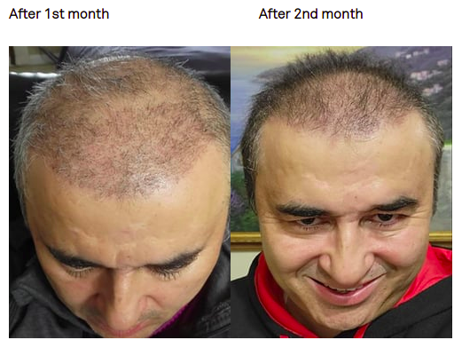 hair transplant results after 2 months