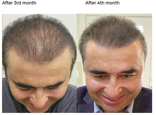 hair transplant results after 3 months