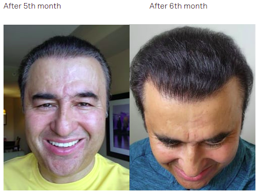 hair transplant results after 5 months