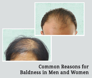 Reason for Baldness in Men and women