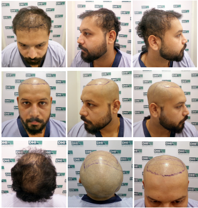 Vaibhav Rawal’s Hair Transplant Surgery Process