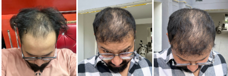 Vaibhav Rawal’s Before Hair Transplant
