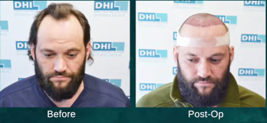 Before and Post Hair Transplant