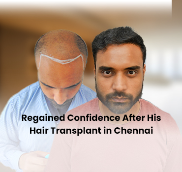 Regained Confidence After His Blog Images Rohit Gupta’s DHI™ Hair Transplant in Chennai