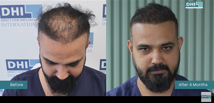 Mr. Bhatiya Hair Transplant Result after 4 month