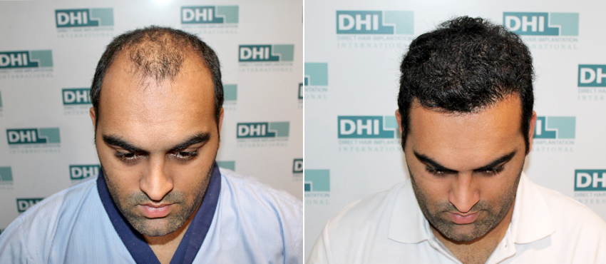 Hair Transplant before and after results