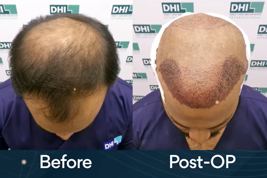 Hair transplantation before and after op