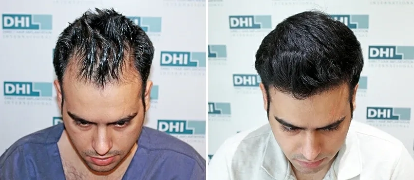 Hair Transplant Results