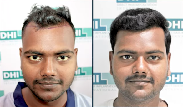 Hair Transplant results