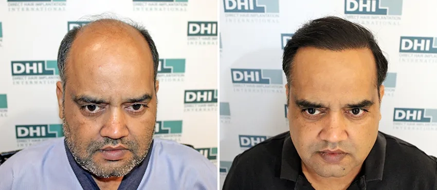 Hair transplant