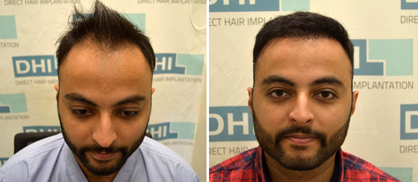Before and After Hair Transplant