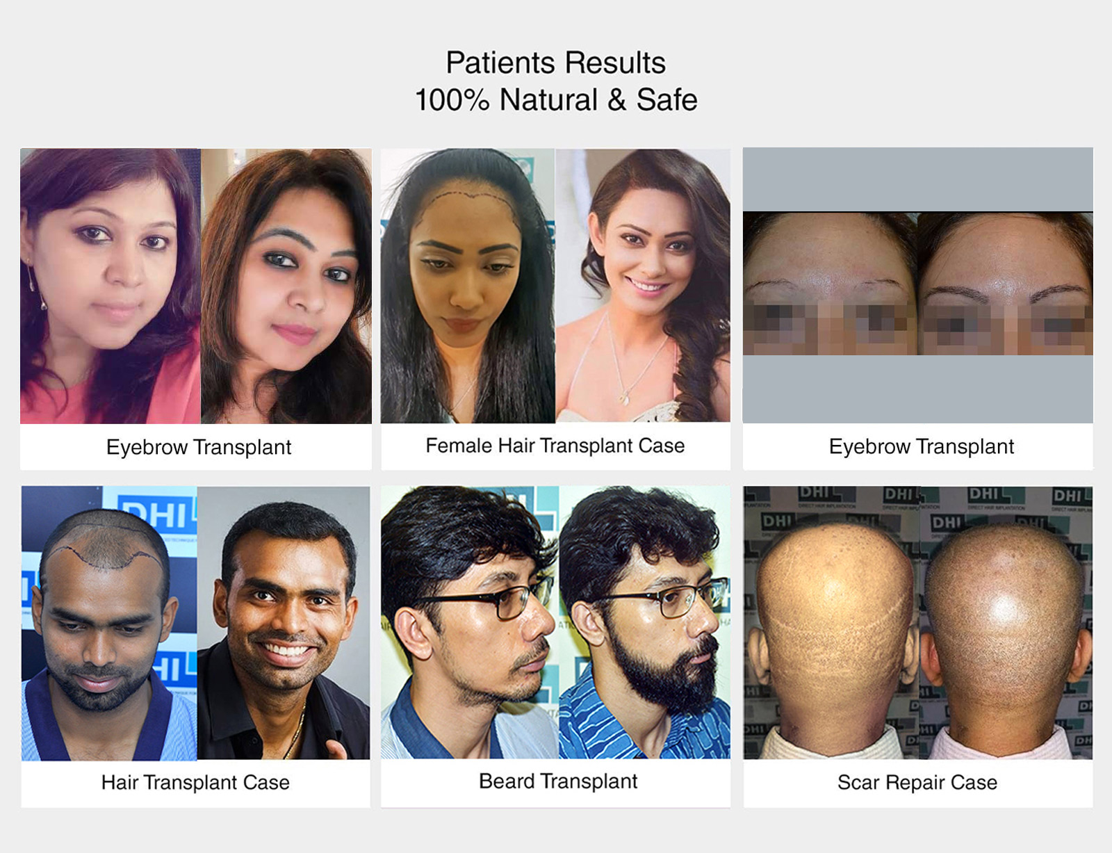 dhi Patient reasult - natural and safe
                     