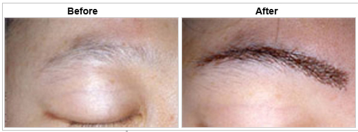 eyebrow hair transplant cost in india