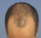 triangular-alopecia