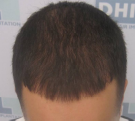 triangular-alopecia