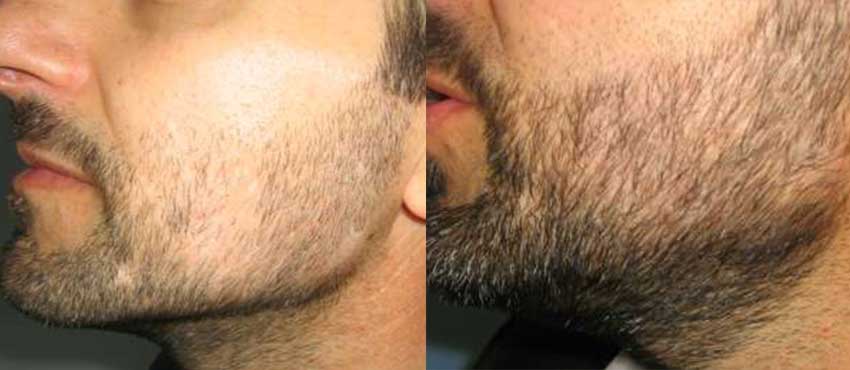 beard hair transplant results