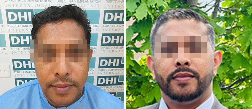 beard hair transplant results