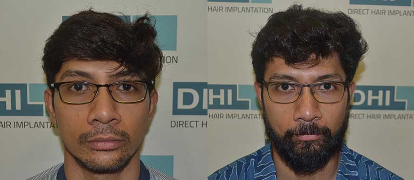 Beard Transplant Results - Beard Before & After Photos - DHI™ India