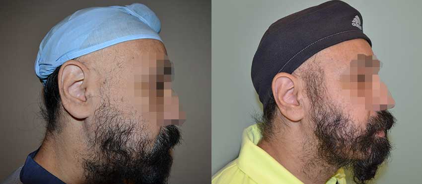  beard hair transplant results
                                         