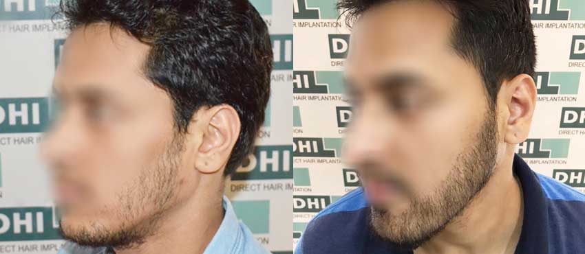 Beard Transplant Before & After Result