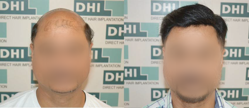  scalp hair transplant results