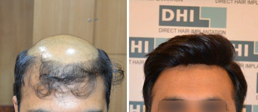 Hair Replacement Results | Amazing Hair Replacement Before & After Results-  DHI