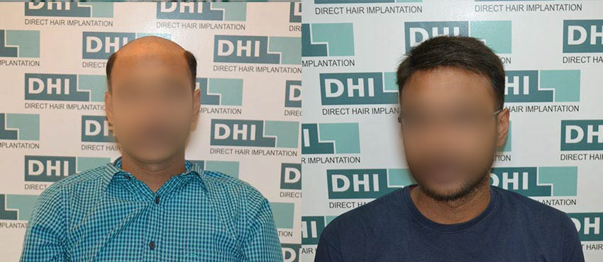  scalp hair transplant results 