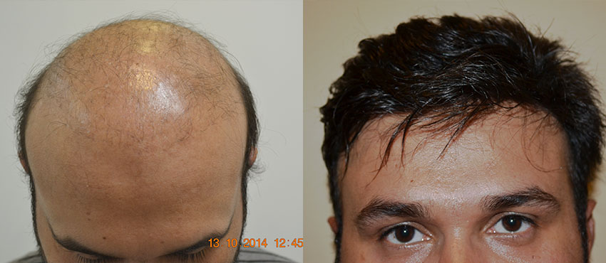  scalp hair transplant results