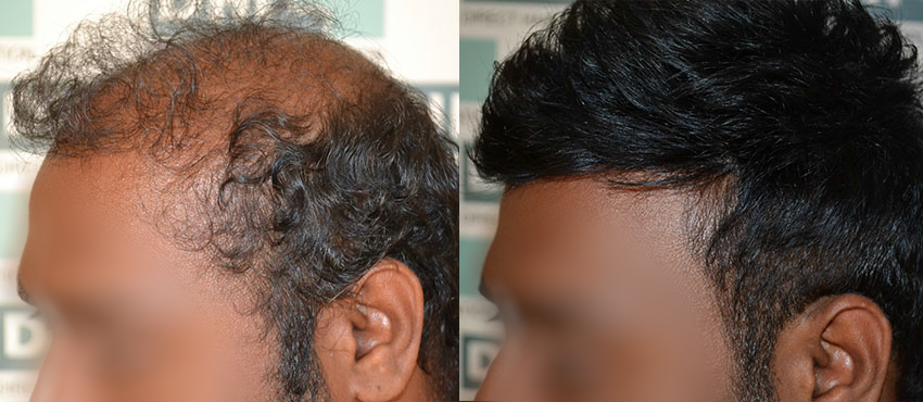  scalp hair transplant results