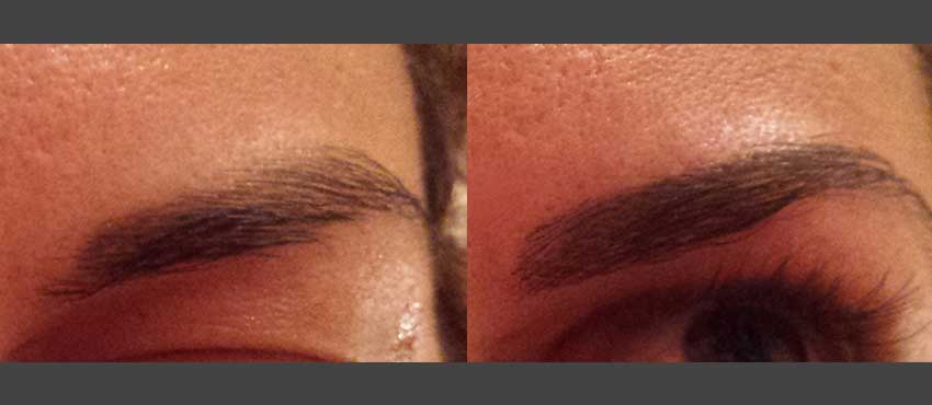 DHI before & after hair transplant results