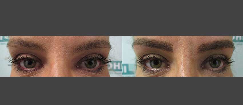 eyebrow restoration before and after image 1
                                         
