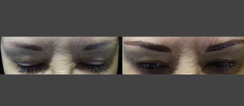 eyebrow restoration before and after image 1
                                         