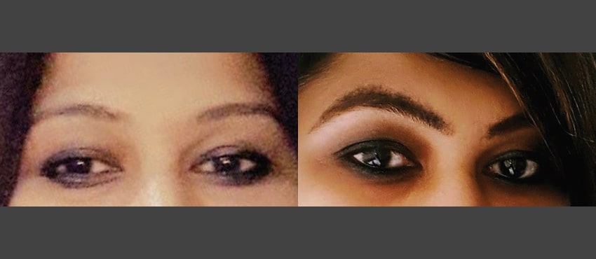 eyebrow restoration before and after image 1
                                         