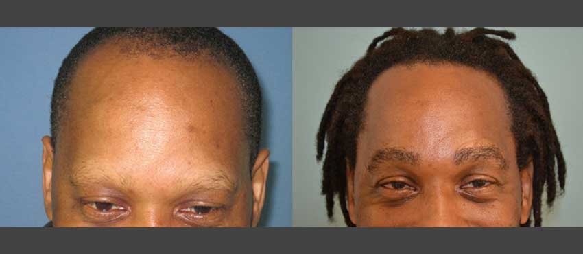 DHI before & after hair transplant results
                                         