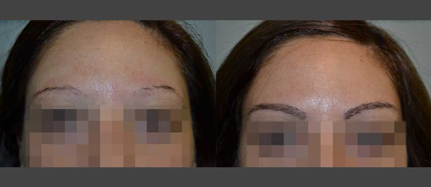 Eyebrow Hair Transplant Results – Eyebrow Before & After Photos - DHI™ India