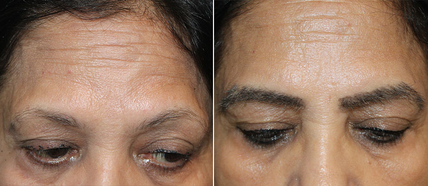 eyebrow restoration before and after image 1
                                         